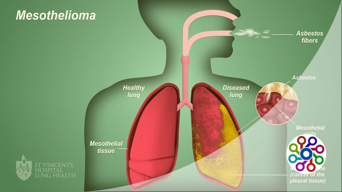 What are the symptoms of mesothelioma