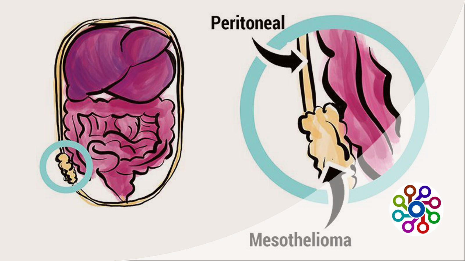 What is epithelial mesothelioma and testicular mesothelioma in 2023