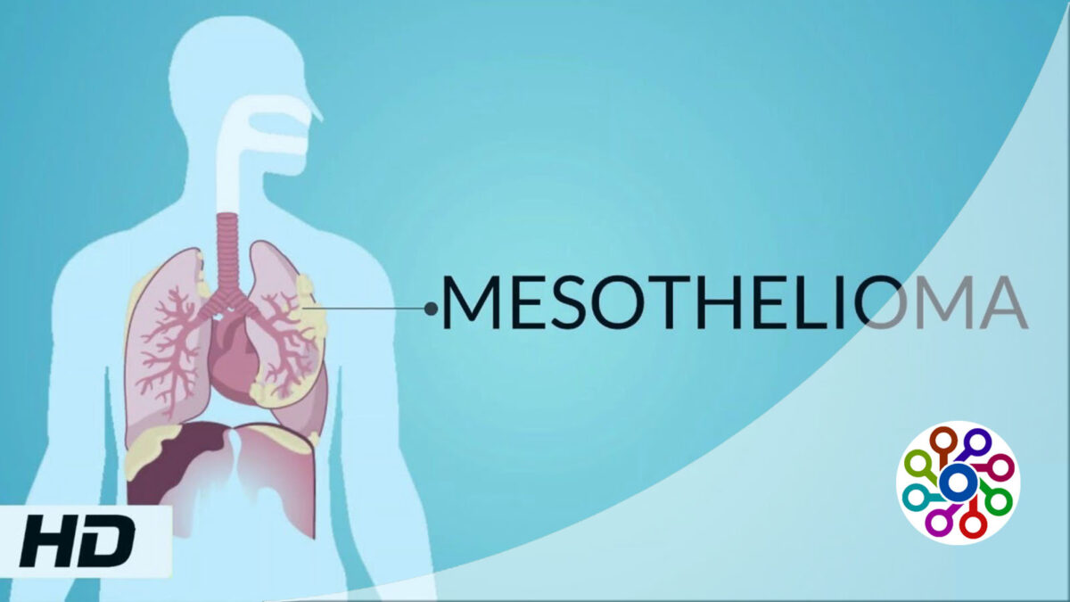 Symptoms of mesothelioma